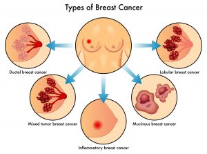 breastcancertypes_inflammatorybreastcancer