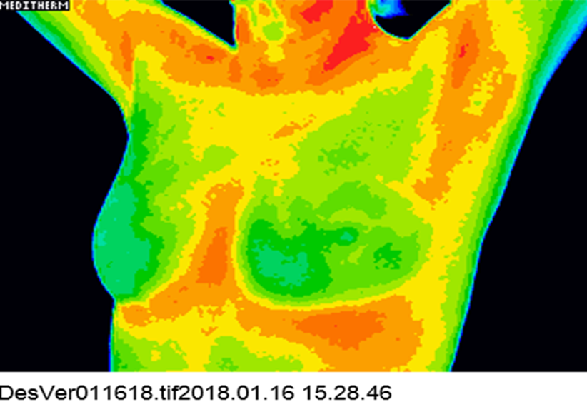 Dr V Thermogram