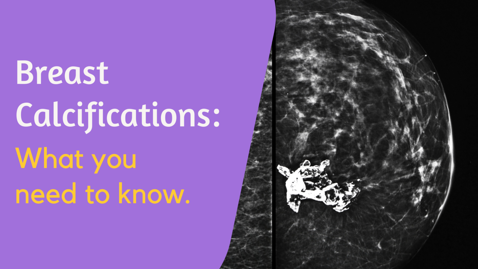 Breast Calcifications What You Should Know Breast Cancer Conqueror