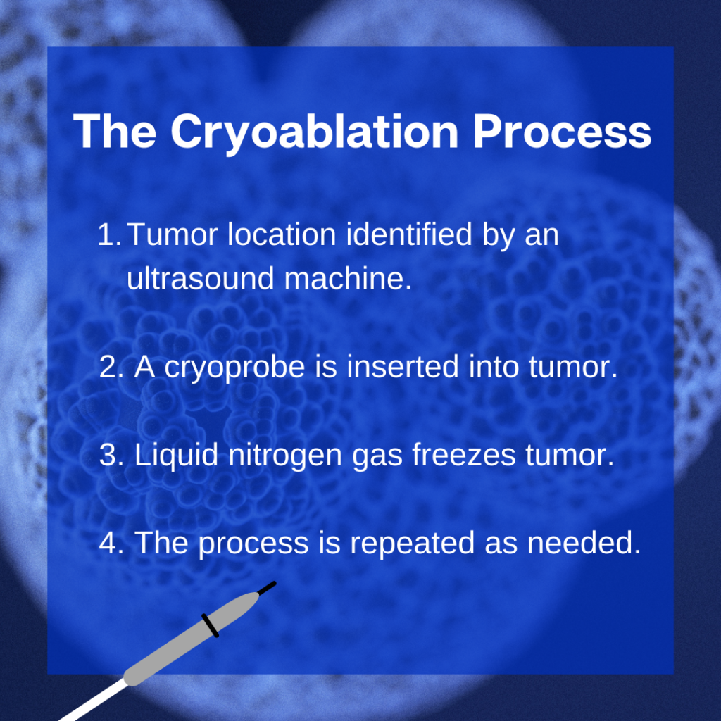 the cryoablation process