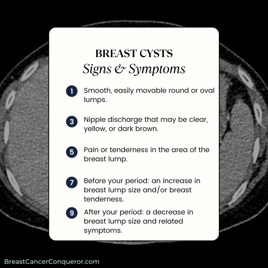 breast cysts signs and symptoms