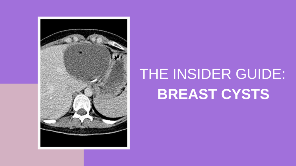 The insider guide to breast cysts