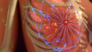 What Is HER2 Positive Breast Cancer?
