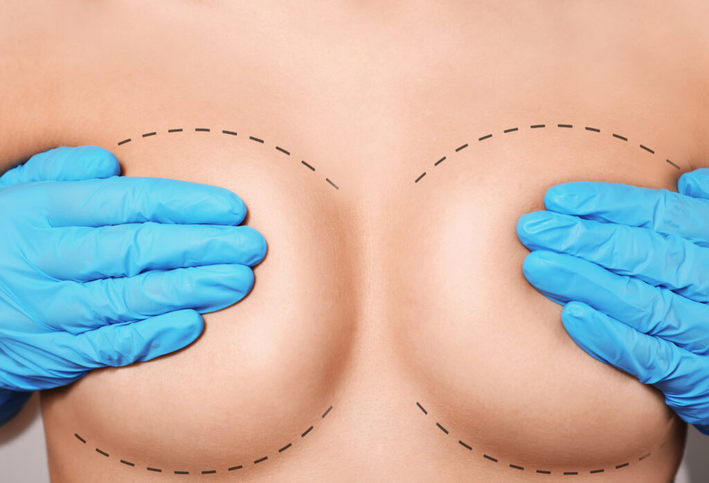 Breast Reconstruction: Get the Facts Before You Decide
