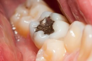 10 Questions About Toxic Amalgams To Ask Your Dentist Now
