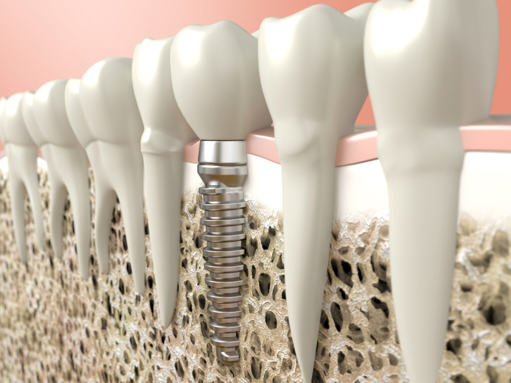 How Safe Are Metal Dental Implants and What Are The Alternatives?