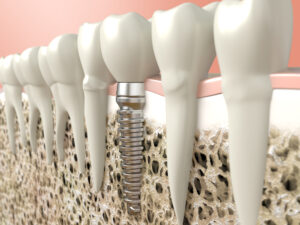 How Safe Are Metal Dental Implants and What Are The Alternatives?