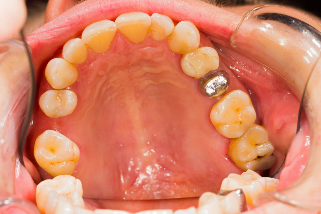 Is Your Dentist SMART About Amalgam Removals? Part 1