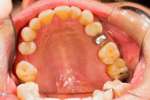 Is Your Dentist SMART About Amalgam Removals? Part 1