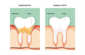 breastcnacer-periodontaldisease